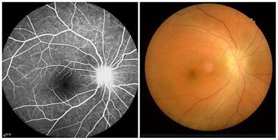Brain Activity Changes in Slow 5 and Slow 4 Frequencies in Patients With Optic Neuritis: A Resting State Functional MRI Study